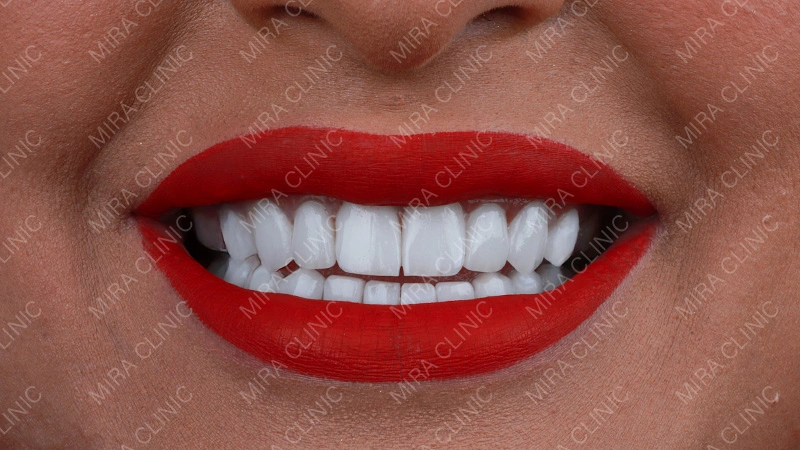 hollywood smile before after celebrities 